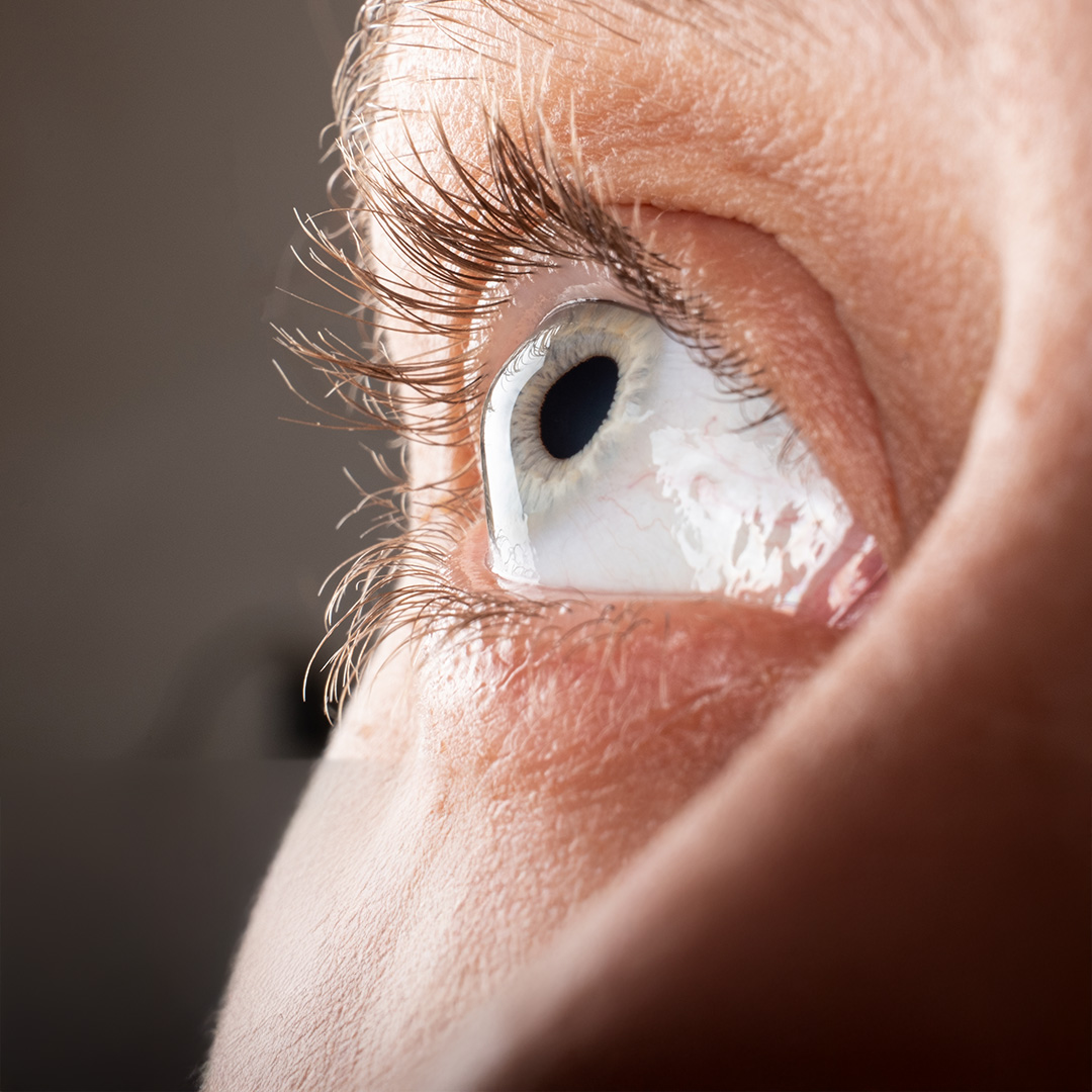 Keratoconus Treatment